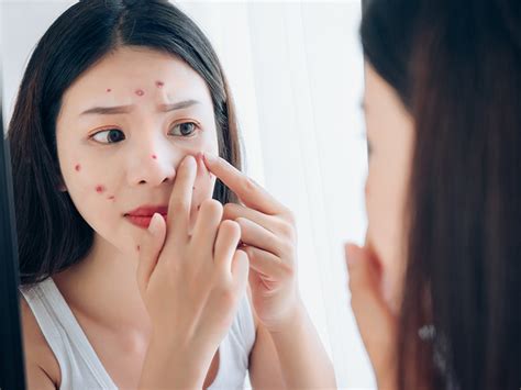 痣怎麼來的|痣 – Hong Kong College of Dermatologists (HKCD)